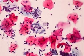 HPV fertőzés - Budai Egészségközpont, Hpv vírus frottis